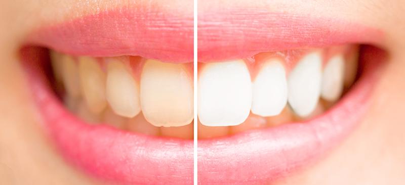 Stained-white teeth contrast